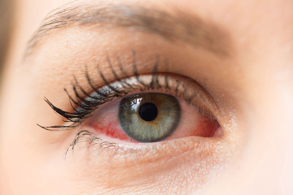 4 natural ways to manage dry eyes