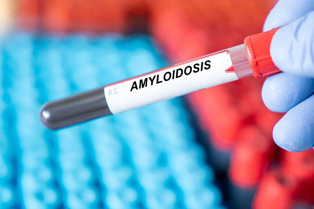 9 early warning signs of amyloidosis to know of