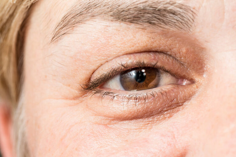 Causes, symptoms, and management of thyroid eye disease